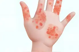 越痒越挠，越挠越痒，牛皮癣该怎么治？您一定不能错过的专家问答图片