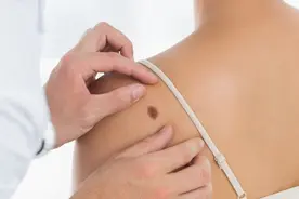 医生提醒：如果痣有这三个特征，最好还是去掉图片