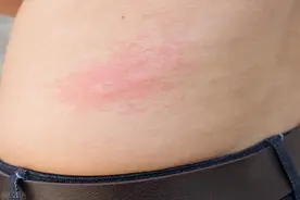 荨麻疹病在皮肤，根在内脏，这样治才能除根。图片
