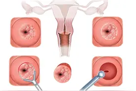 宫颈锥切术前必看！这6件事做不好，可能影响手术效果！图片