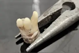 英国一男子牙疼，预约6个月无果，实在疼得难受，自己拿钳子拔牙图片