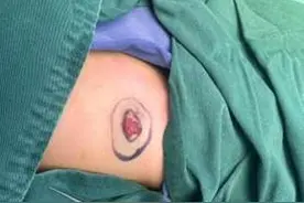 精准呵护，无痕关爱自治区南溪山医院整形外科成功为4月龄婴儿实施超减张缝合血管瘤精准切除图片