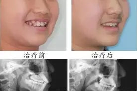牙科知识 | 矫牙（正畸）篇图片