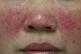 4年玫瑰痤疮久治无果，我用一方治好，把血凉下来，把毒放出去图片