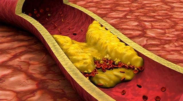 马上停止5类运动，很可能加速血栓形成！等血管堵死就迟了