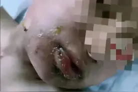 太可怕了！开水直接灌进嘴里，七年级男孩疑遭霸凌，警方介入处理图片