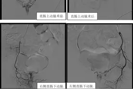 介入微创治疗拿捏老痔疮 齐医附属三院新疗法轻松解决后“股”之忧图片