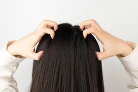 头痒、出油，头皮屑不断？教你如何解决“脂溢性皮炎”图片