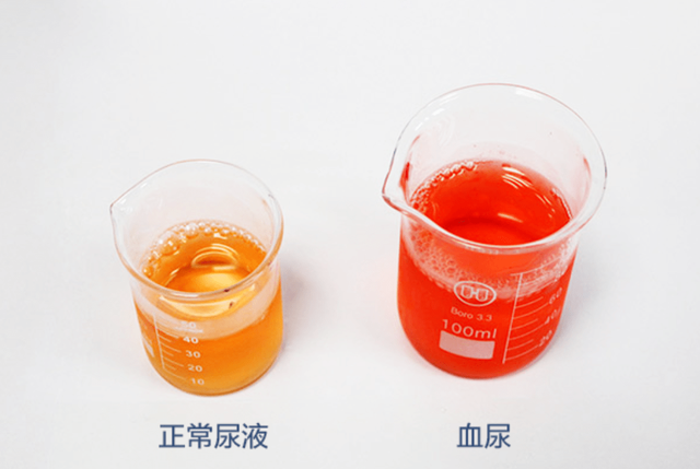 医生提醒：出现这种尿，可能有肿瘤！这些预警信号，别忽视了