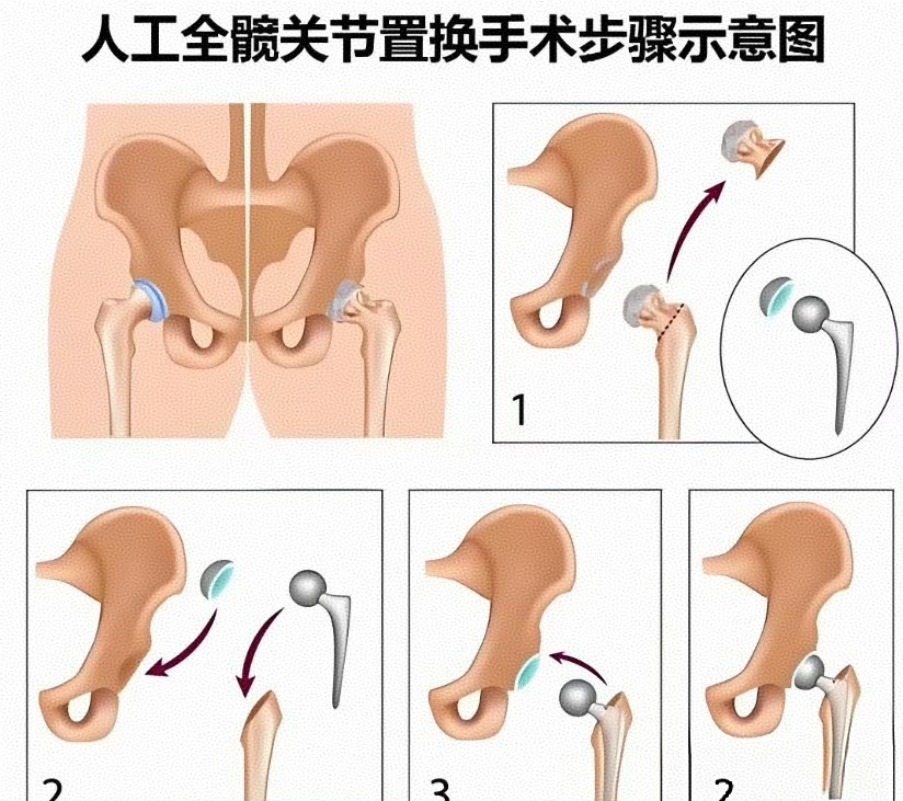 郎平膝蓋頸椎髖關(guān)節(jié)都置換了 傷痛伴隨一生