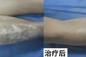 每日三餐，养生之道！白癜风康复从简易食谱开始图片