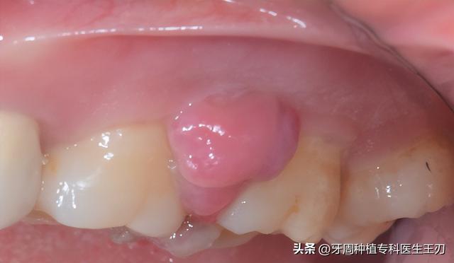 牙龈增生的原因和治疗方法