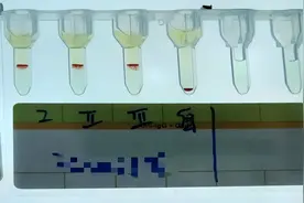 云南检出一例！比熊猫血还稀有小p血型是什么？图片