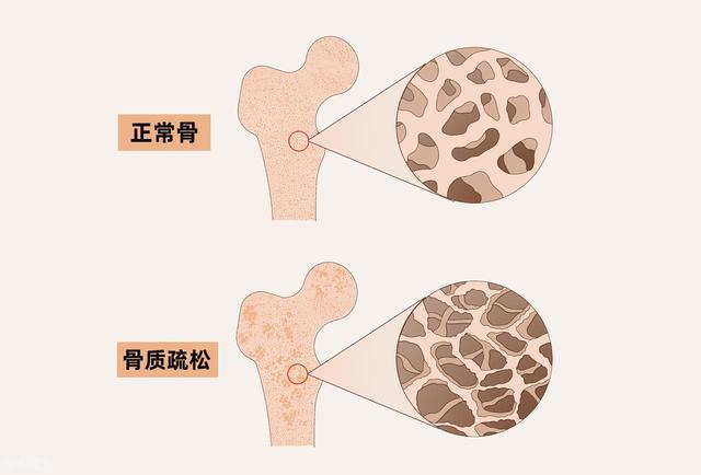 学医后才明白，增强骨密度最好的运动，不是散步游泳，而是这个