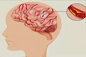 发现“腔梗”，最重要的治疗是什么？往往不是他汀或阿司匹林！图片
