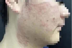 梅雨季高发，一人感染可传染全家！27岁小伙一次失误差点毁容图片