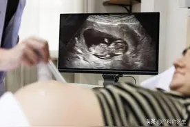 孕早期必检超声项目NT，产科医生一篇全讲透。图片