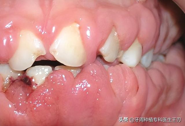 牙龈增生的原因和治疗方法