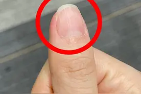 指甲出现这些纹路，是身体在发出“警报”？多图详解图片