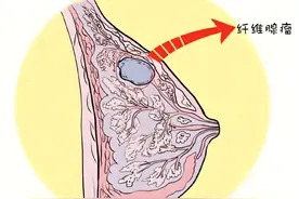 乳腺纤维瘤警报：这三种情况，及时治疗防恶变！图片