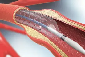 装上心脏支架后，还能活多少年？医生不再隐瞒，说出答案图片