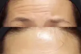 停止衰老的魔力针“肉毒素”的除皱与提升图片