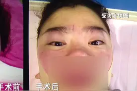 花7万元整形 术后“像猪脑袋”？人脸识别系统懵圈图片