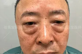 55岁去了趟上海做眼袋，手术长达40分钟，术后像45岁的人吗图片