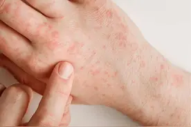 提醒：这 5 类常见食物容易引起过敏！易过敏体质人群要小心图片