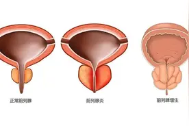 前列腺增生的四大首选治疗药物，你知道几个图片