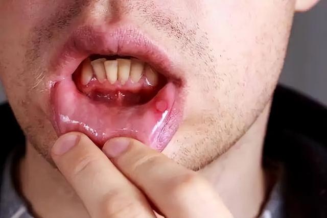 牙龈出血伴3种表现，白血病可能进入危险期了，赶紧查血常规