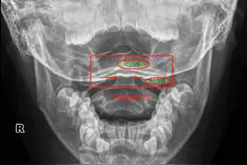 六岁男孩突然一扭头，脖子竟然歪了！图片