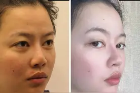 隆鼻常用的6种材料，一篇文章把优缺点讲清楚！（下）图片