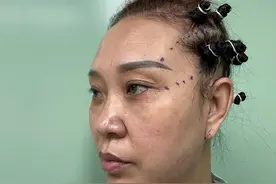 51岁挑战全脸拉皮，第9天丈夫说有点丑，30天后美得认不出！图片