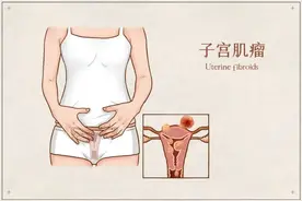 这个肿瘤不用开刀也能治！在女性群体中很常见图片