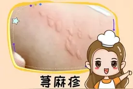 荨麻疹，病在皮肤，病机在脏腑，中医分享5个不复发的招数图片