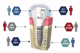种植牙教你三点，帮你拿到高性价比的种植方案图片