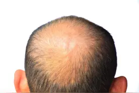 脱发——老中医：秃顶说明你“肝肾两虚”图片