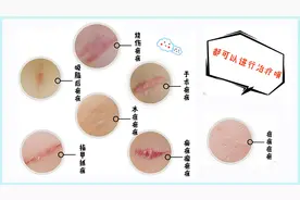 揭秘疤痕增生的真相！皮肤科医生单孔荣告诉你疤痕发病原因和修复图片