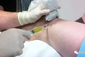 膝盖有积液？处理治疗一看就明白图片