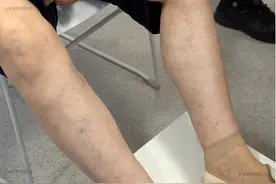 治疗静脉曲张很简单，无非就是两种方法图片