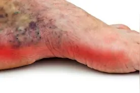 腿上有这6个表现，多半是糖尿病神经性病变，尽快就医，别拖成糖尿病足！图片