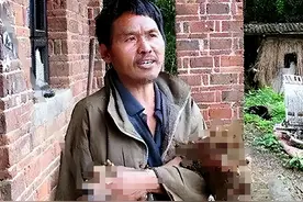 湖南“树人”刘忠文：双手长满树枝，怪病缠身，穿衣吃饭父母代劳图片