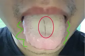 舌苔厚腻发黄，还有裂纹，若当成湿热来调理，清十年也没用！图片