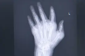 大学生手里长满“石头”，医生：这种病会把骨头“吃掉”！图片