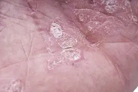 体癣是什么东西？可怕吗？图片