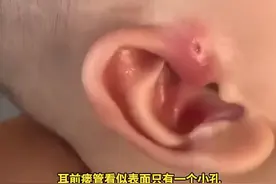 耳朵上的聪明洞原来是胚胎发育不全图片