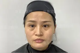 记录32岁去眼袋＋泪沟手术过程，恢复期太煎熬，15天后长这样图片