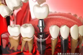 种植牙术后应如何护理？需注意这8点！图片