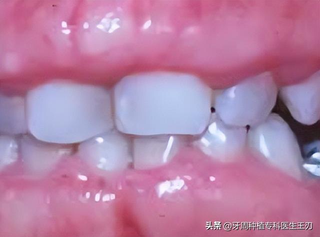 牙龈增生的原因和治疗方法